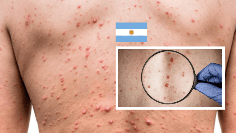 Primer caso en Latinoamérica: Argentina confirma paciente con viruela del&nbsp;mono