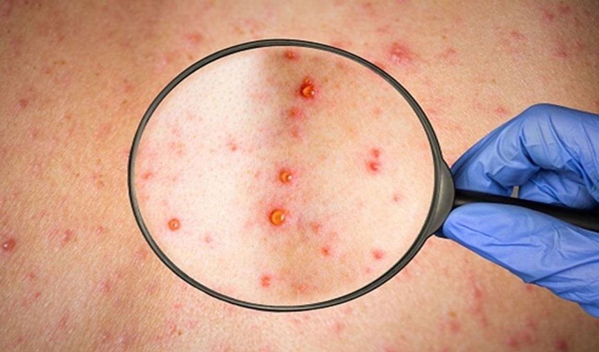 Chile confirma primer caso de viruela del&nbsp;mono