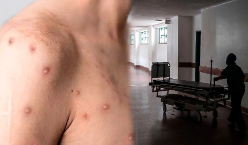 Confirman primera muerte por viruela del mono en&nbsp;Brasil