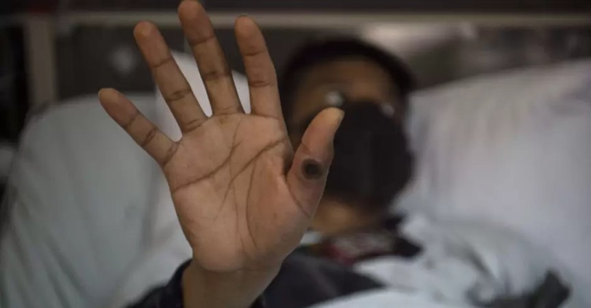 Viruela del mono: ¡Alarma mundial! Reportan primer caso de cepa mortal fuera de&nbsp;África